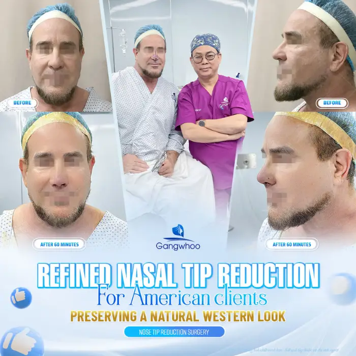 Nose Tip Plasty - Improve Large and Rough Nose Tip
