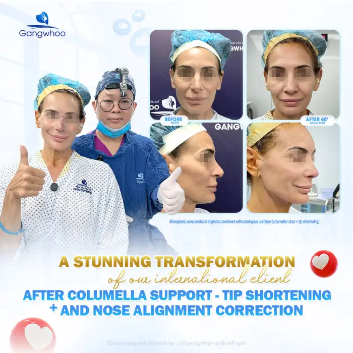 nose tip reduction