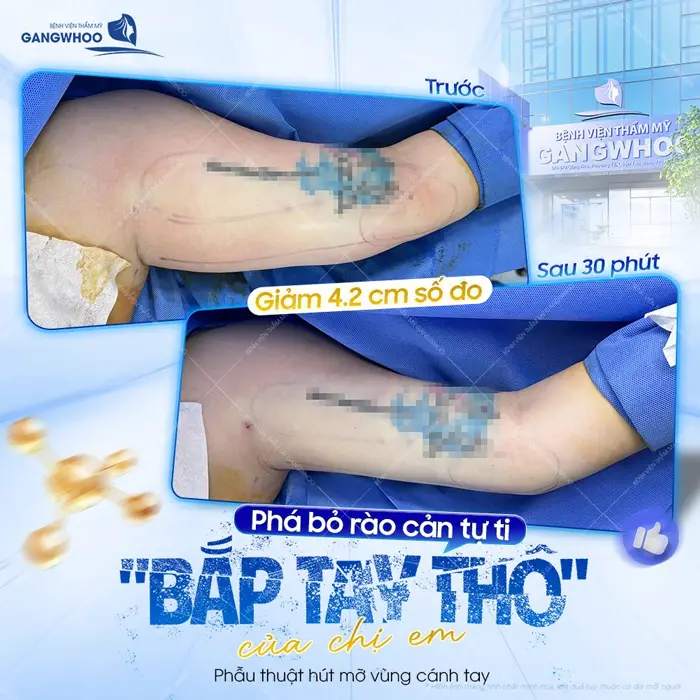 pha bo rao can tu ti cua chi em sau 30 phut phau thuat thuc hien 1