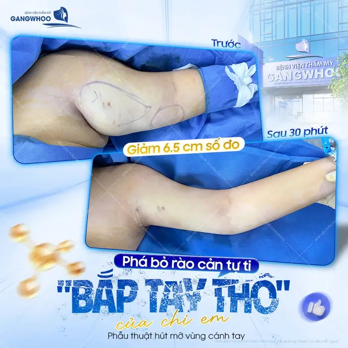 pha bo rao can tu ti cua chi em sau 30 phut phau thuat thuc hien 2