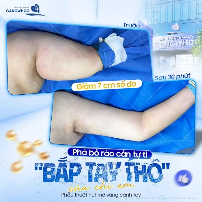 pha bo rao can tu ti cua chi em sau 30 phut phau thuat thuc hien 3