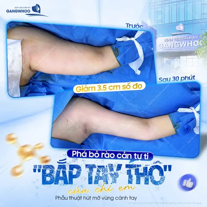 pha bo rao can tu ti cua chi em sau 30 phut phau thuat thuc hien 4