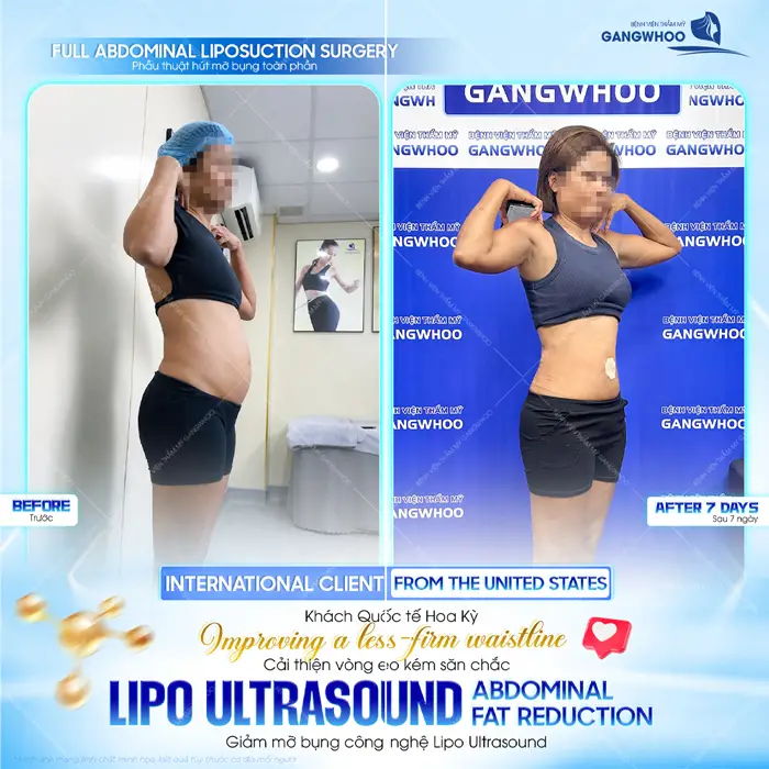 Phẫu thuật hút mỡ bụng toàn phần khách quốc tế đến từ Hoa Kỳ cải thiệ vòng eo kém săn chắc 