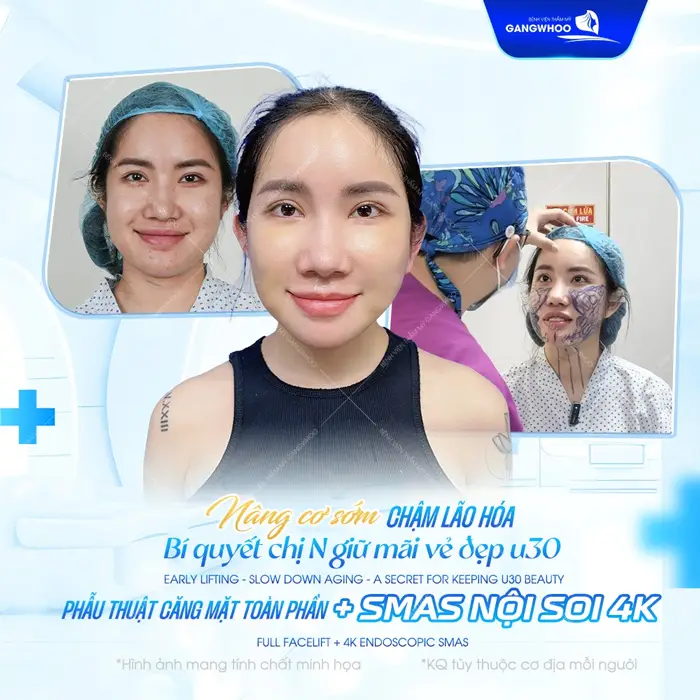 Căng Da Mặt Toàn Phần - Bí Quyết Trẻ Hóa Không Để Lại Sẹo 5 Phẫu thuật căng da mặt toàn phần nâng cơ cải thiện tình trạng da lão hóa một cách hiệu quả