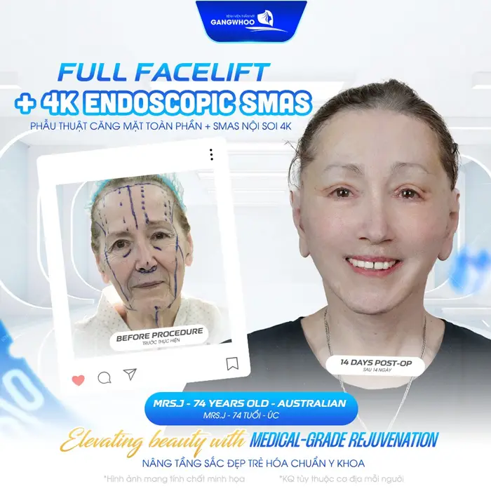 Căng Da Mặt Toàn Phần - Bí Quyết Trẻ Hóa Không Để Lại Sẹo 3 Phẫu thuật căng da mặt toàn phần Smas nội soi nâng tầm nhan sắc tự tin với diện mạo trẻ hóa dài lâu