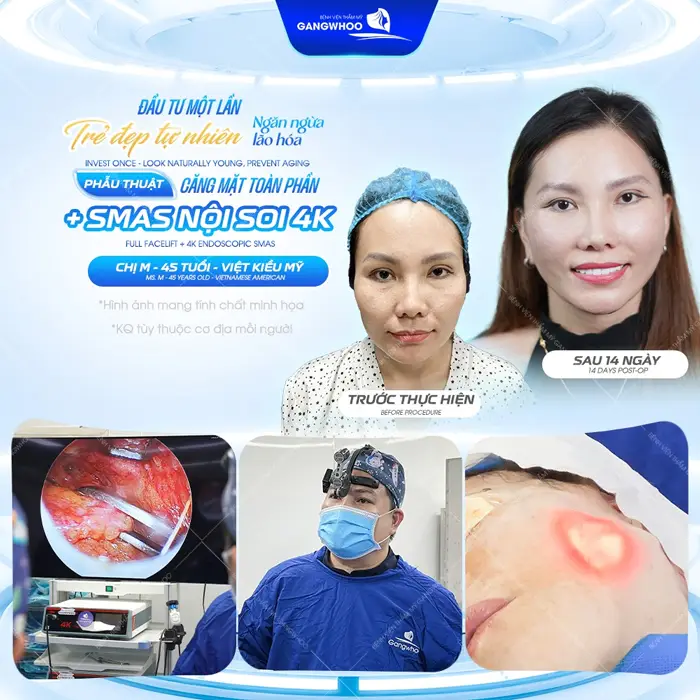 Căng Da Mặt Toàn Phần - Bí Quyết Trẻ Hóa Không Để Lại Sẹo 4 Phẫu thuật căng da mặt toàn phần gương mặt trẻ đẹp ngăn ngừa làn da lão hóa hiệu quả