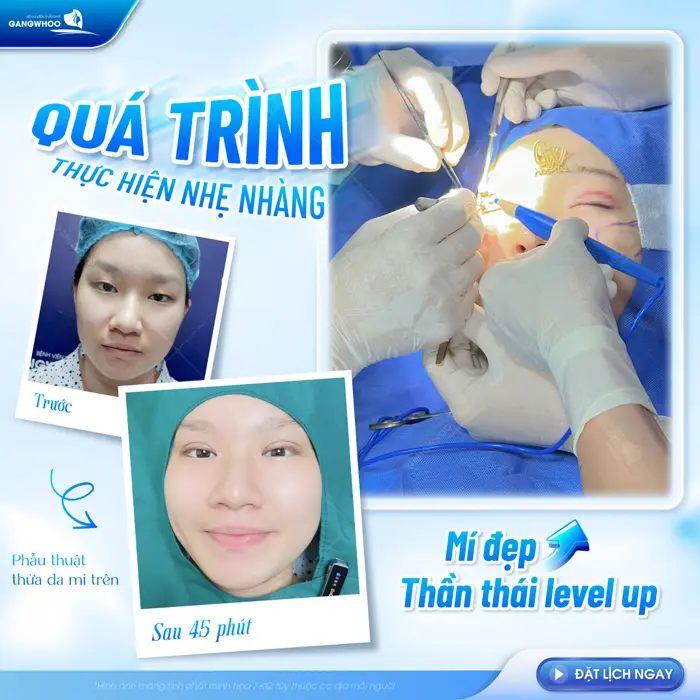 Quá trình thực hiện nhẹ nhàng, mí đẹp chuẩn thần thái sự cải thiện sau 45 phút phẫu thuật 