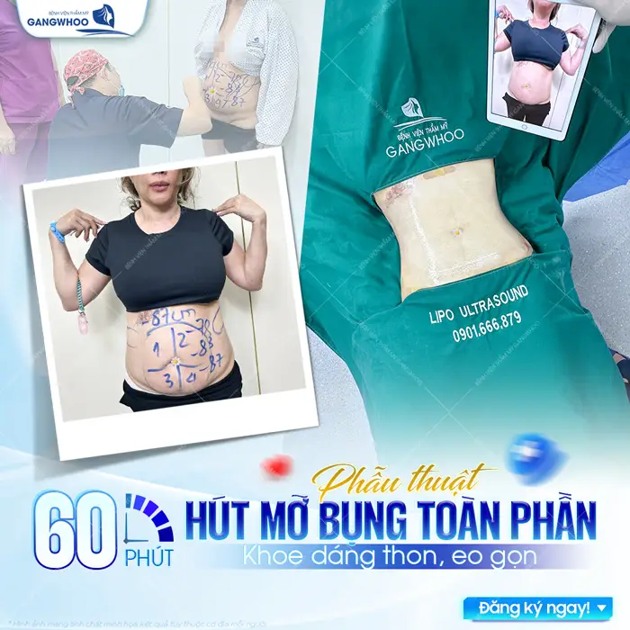 Phẫu thuật hút mỡ bụng toàn phần khoe dáng thon, eo đẹp nhẹ nhàng