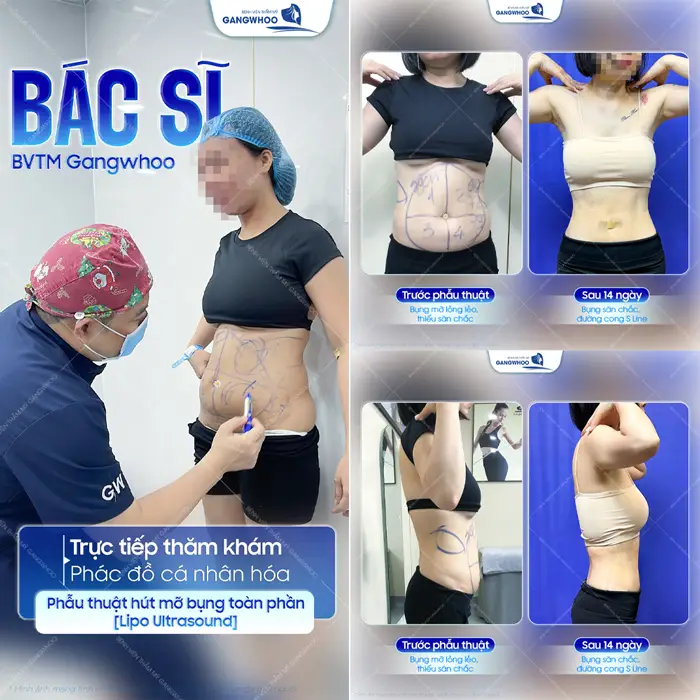 Phẫu thuật hút mỡ bụng toàn phần sự cải thiện sắc vóc rõ rệt qua từng ngày