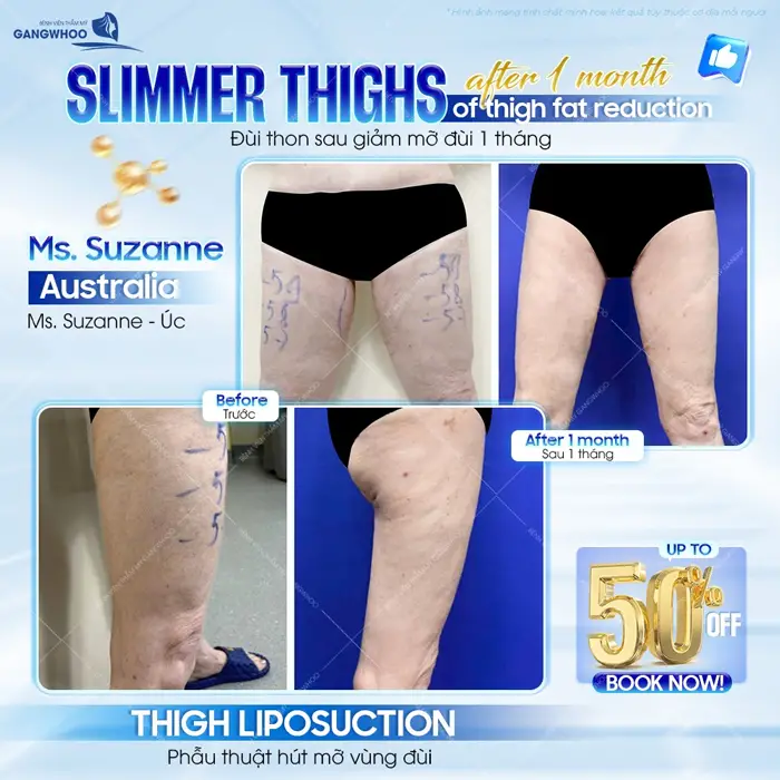 Phẫu thuật hút mỡ đùi cho khách hàng đến từ Úc sau 1 tháng đã đẹp và cải thiện thấy rõ 