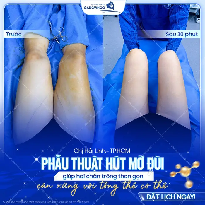 Phẫu thuật hút mỡ đùi giúp 2 chân thon gọn cân xứng với tổng thể cơ thể sau 30 phút kết quả đã thay đổi rõ rệt