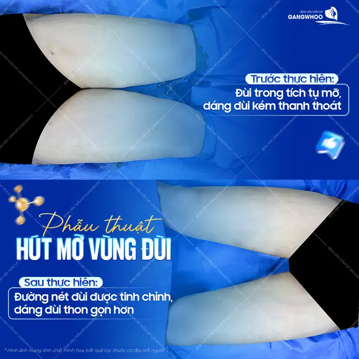 Phẫu thuật hút mỡ vùng đùi sau thực hiện đường nét đã được tinh chỉnh với phần đùi đẹp thon gọn và mềm mại 