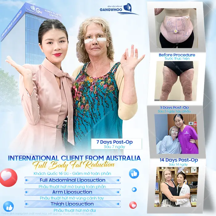 Phẫu thuật hút mỡ bụng toàn phần tự tin với vóc dáng mới cân đối và thon gọn hơn