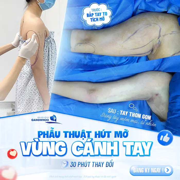 Phẫu thuật hút mỡ vùng cánh tay 30 phút thay đổi hoàn toàn đôi tay thô kệch hiệu quả