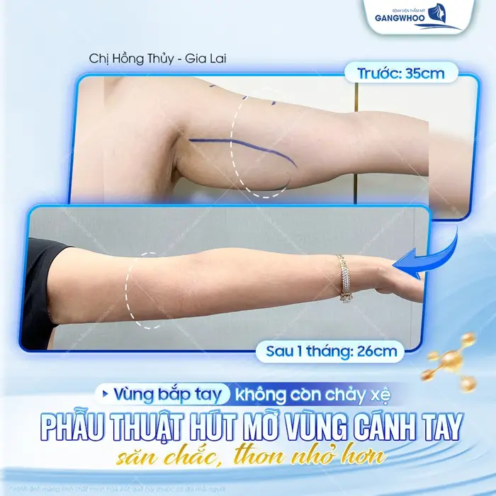 Vùng bắp tay khôgn còn chảy xệ sau 1 tháng đã săn chắc và thon gọn thấy rõ