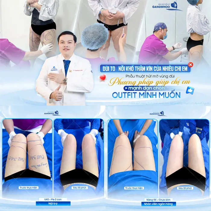 Đùi to, nỗi khổ thầm kín của nhiều chị em phương pháp làm đẹp giúp chị em tự tin cân mọi outfit mình muốn