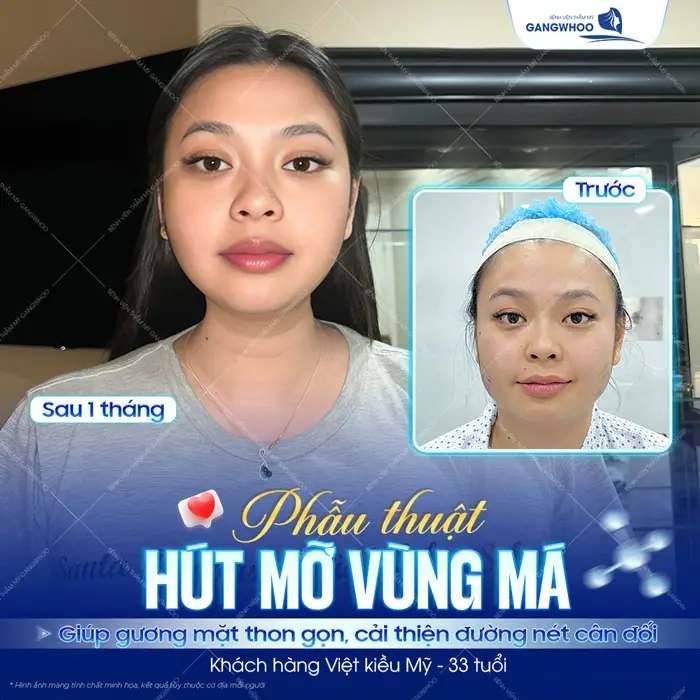 Phẫu thuật hút mỡ vùng má giúp gương mạt thon gọn cải thiện đường nét gương mặt đầy cân đối và hài hòa