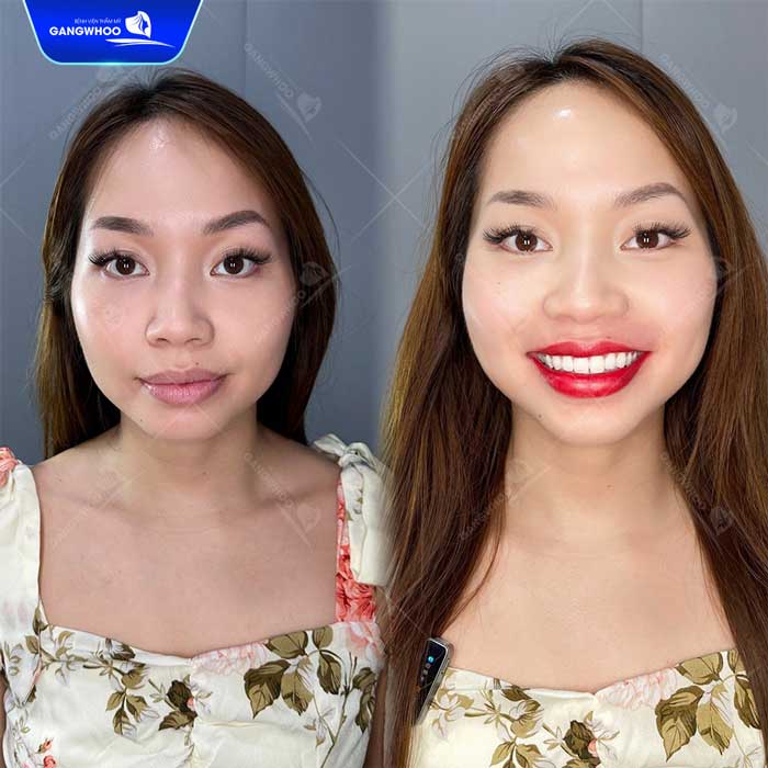 Phun Môi Là Gì? Khác Gì Xăm Môi? Top 9 Màu Hot 2025 11 Khách hàng Phun môi màu đỏ cherry tại Bệnh viện thẩm mỹ Gangwhoo
