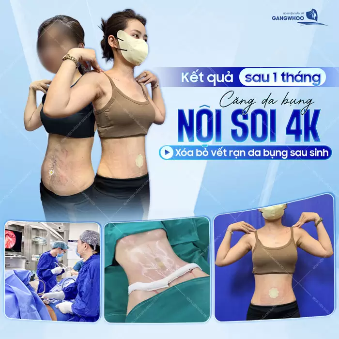 Căng Da Bụng Là Gì? Trường Hợp Nào Nên Và Không Nên Thực Hiện 10 Sau căng da mặt 1 tháng căng da bụng nội soi 4K xóa bỏ vết rạn da bụng sau sinh hiệu quả và an toàn