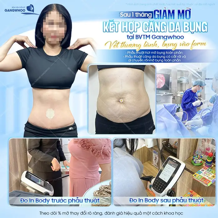 Kết quả sau 1 tháng giả mỡ kết hợp căng da bugnj tại BVTM Gangwhoio bụng phẳng lỳ eo thon đẹp thấy rõ