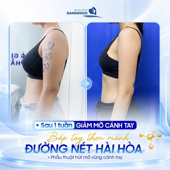 Sau 1 tuần giảm mỡ cánh tay đường bắp tay đẹp thon mảnh tăng đường nét hài hòa cho cơ thể