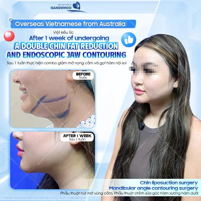 Sau 1 tuần giảm mỡ nọng cằm đường nét gương mặt đẹp thăng hạng và thon gọn hơn thấy rõ