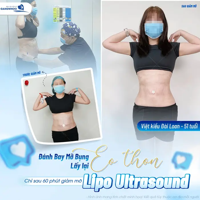 Đánh bay mỡ bụng lấy lại eo thon sau 60 phút giảm mỡ (Lipo Ultrasound)
