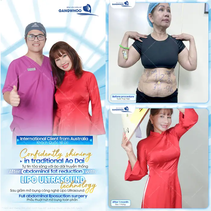 Khách hàng Úc hài lòng sau giảm mỡ bụng thành công tại bệnh viện thẩm mỹ Gangwhoo 