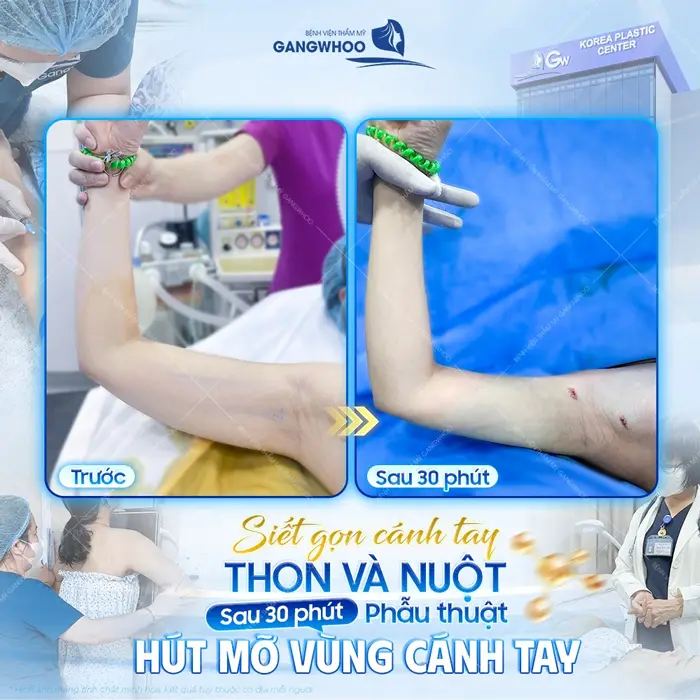 Siết gọn cánh tay thon và nuột sau 30 phút phẫu thuật hút mỡ vùng cánh tay đôi tay đã thon đẹp xuất sắc
