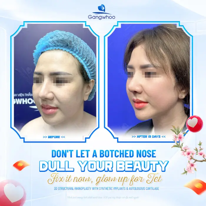 structural rhinoplasty 1