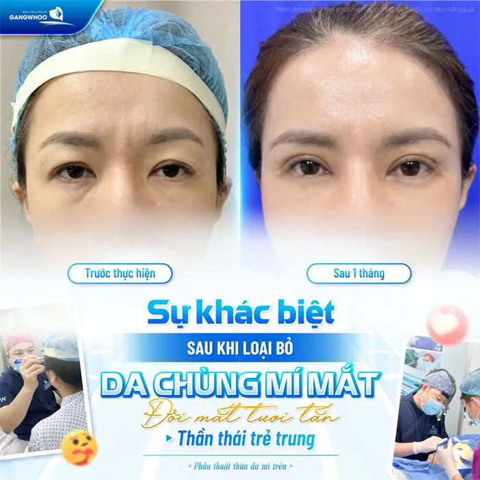 Sự khác biệt của đôi mắt sau loại bỏ da chùng mí mắt đôi mắt thêm tươi tắn thần thái thêm trẻ trung 