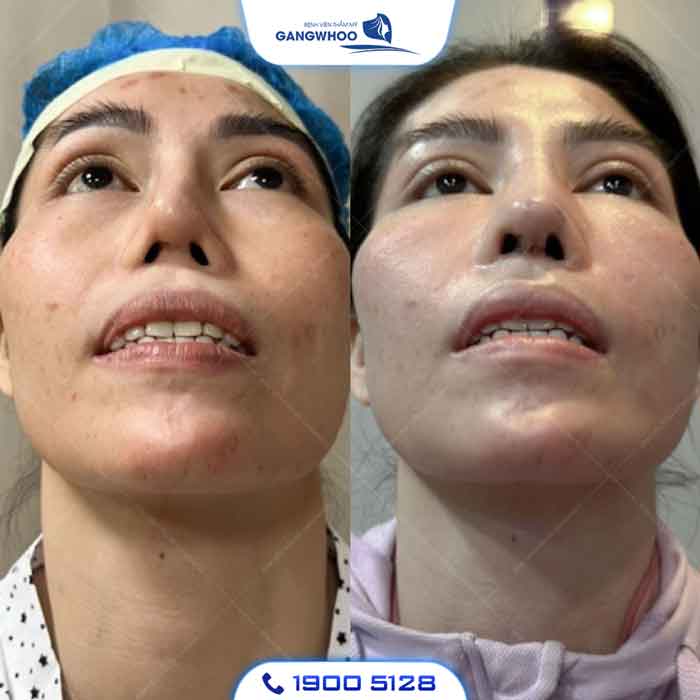 Khách hàng sửa mũi hỏng thành công đầu mũi cong