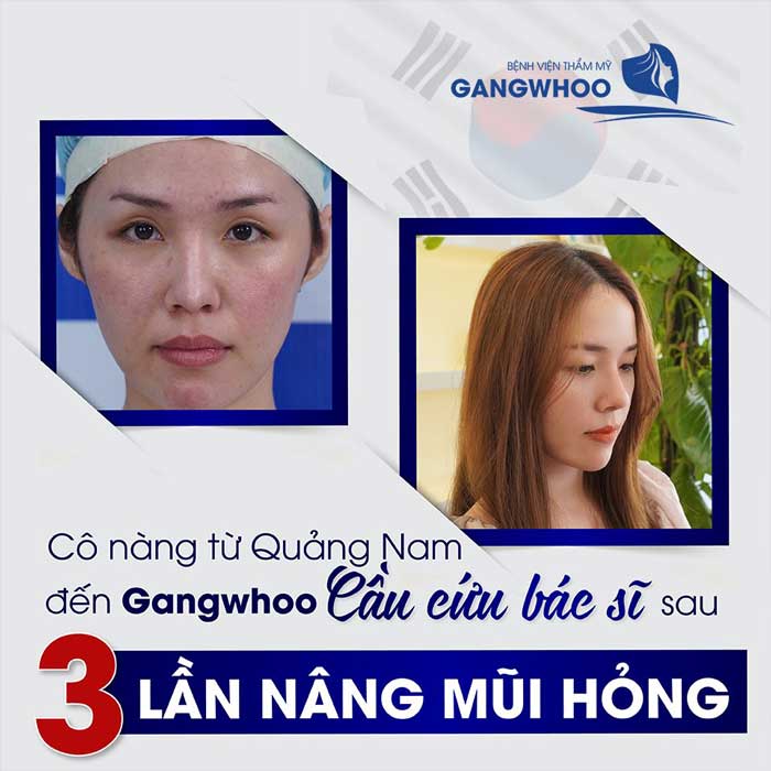 sửa mũi hỏng tại bệnh viện thẩm mỹ Gangwhoo