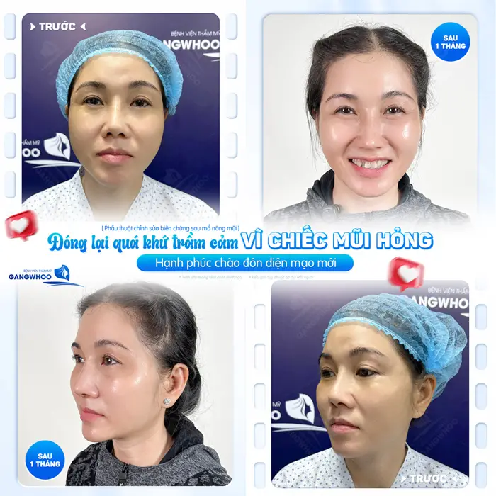 Đóng lại quá khứ trầm cảm vì chiếc mũi hỏng, sau 1 tháng thực hiện khách hàng hạnh phúc vì diện mạo mới
