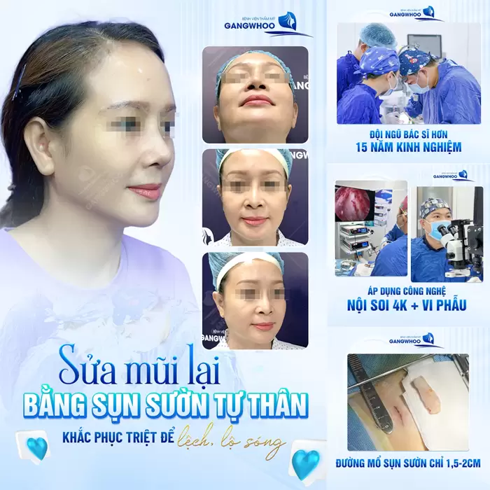 Sửa Mũi Hỏng Phương Pháp Khắc Phục Biến Chứng Sau Nâng Mũi 4 Sửa lại mũi bằng sụn sườn tự thân khắc phục triệt để mũi lệch, lộ sóng một cách hiệu quả và an toàn