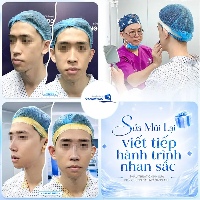 Sửa mũi lại viết tiếp hành trình tìm lại nhan sắc đẹp thăng hạng sau phẫu thuật 