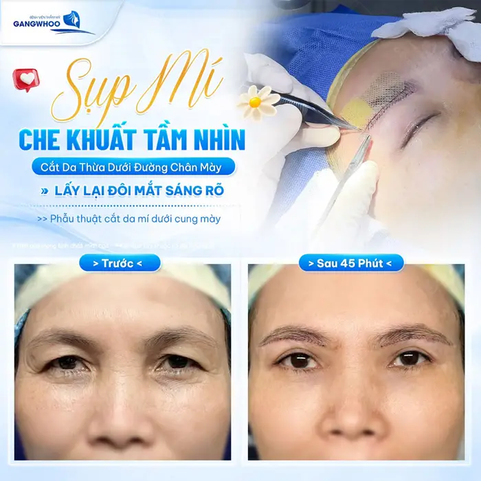 Phẫu Thuật Treo Cung Mày Trực Tiếp Nội Soi (Nâng Cung Chân Mày) Thổi Bay Dấu Hiệu "Lão Hóa" 7 Sụp mí che khuất tầm nhìn cắt da thừa qua đường chân mày lấy lại đôi mắt sáng rõ đầy tươi tắn