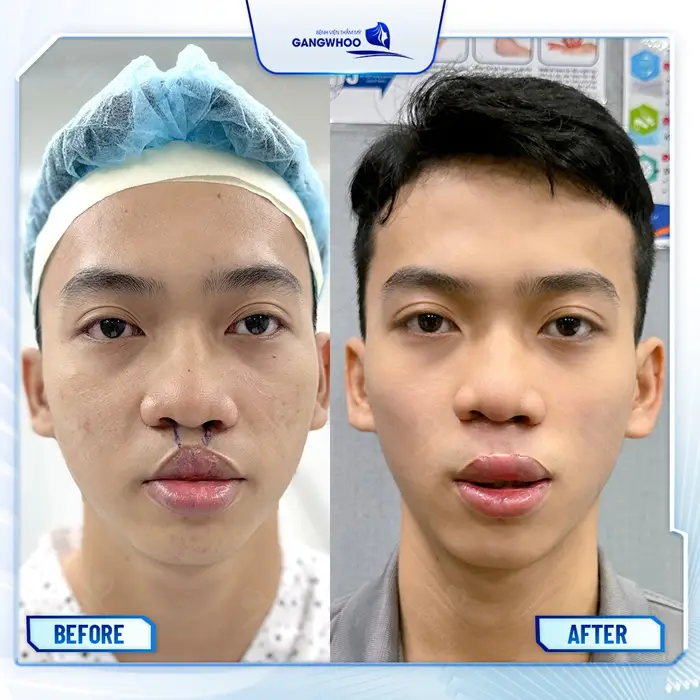 Điều Trị Sứt Môi Hở Hàm Ếch Bằng Kỹ Thuật Chuyển Vạt Da AB 24 Điều Trị Sứt Môi Hở Hàm Ếch Bằng Kỹ Thuật Chuyển Vạt Da