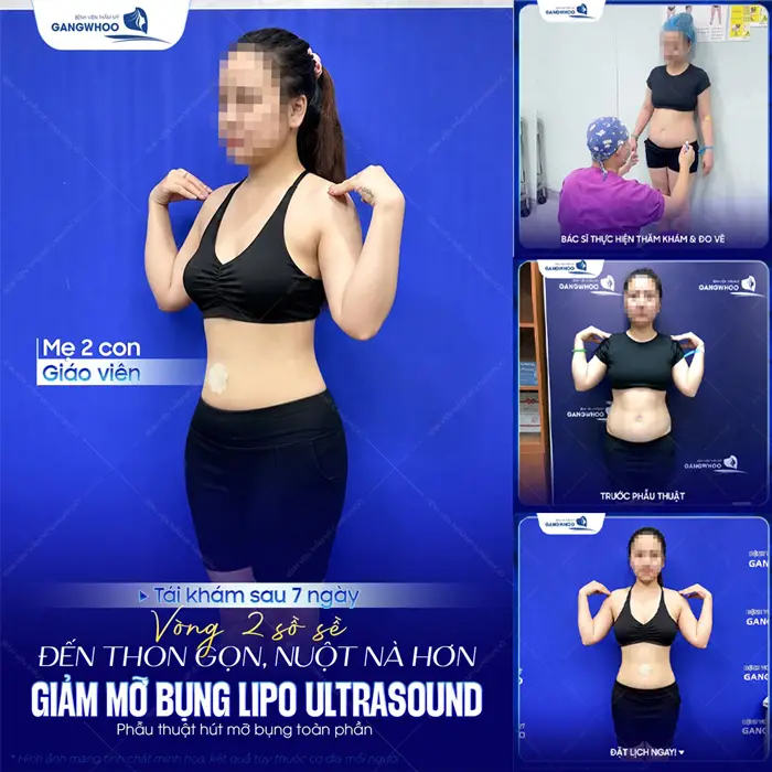 Tái khám sau 7 ngày siết eo thon, bụng phẳng nuột màn thay đổi đầy bất ngờ sau giảm mỡ công nghệ Lipo Ultrasound