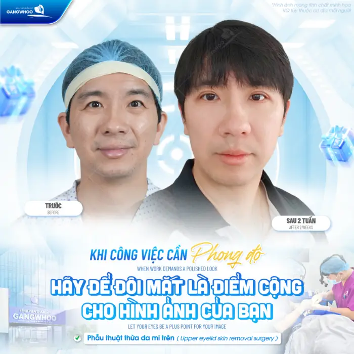 Phẫu thuật cắt da thừa mi trên và tái tạo mỡ mắt: Xóa bỏ bọng mỡ, lấy lại đôi mắt trẻ trung.