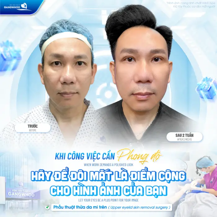 Phẫu thuật mi trên: Loại bỏ da thừa và phân bố lại mỡ mắt, giúp đôi mắt linh hoạt, rạng rỡ