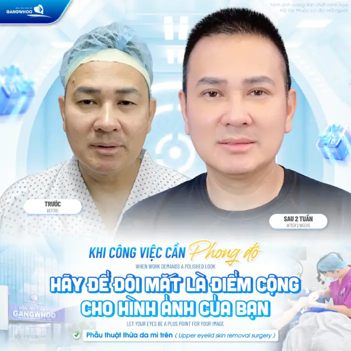 Tái tạo mỡ mắt kết hợp loại bỏ da chùng mi trên – Giải pháp trẻ hóa vùng mắt toàn diện, tự nhiên