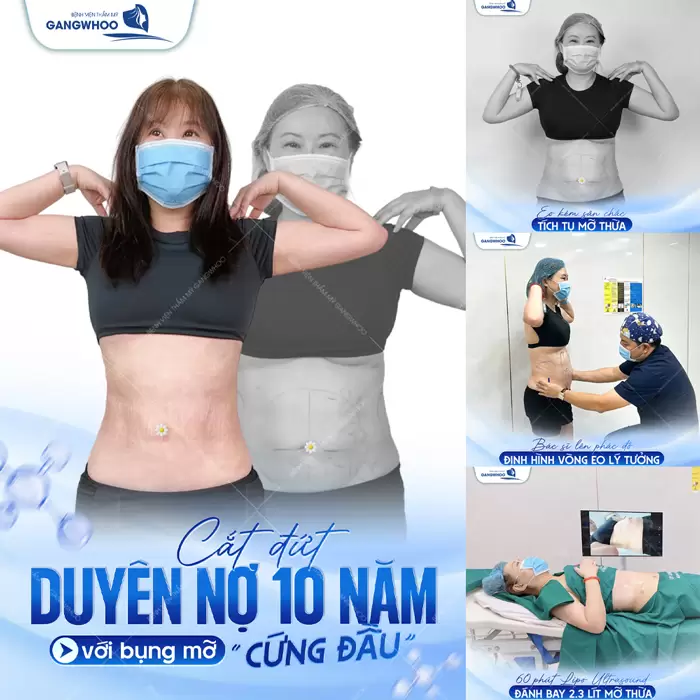 Lipo Ultrasound: Công Nghệ Hút Mỡ Được Nhiều Khách Quốc Tế Lựa Chọn 35 Giảm mỡ hiệu quả tự tin với vòng eo siêu cuốn hút tại BVTM Gangwhoo