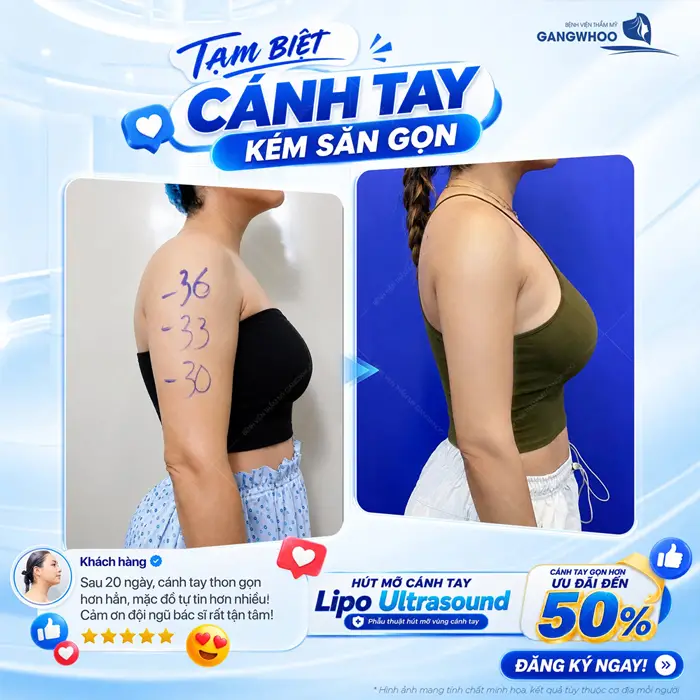 Phẫu Thuật Hút Mỡ Vùng Cánh Tay Giúp Đôi Tay Thon Gọn Nhanh Chóng 33 tam biet canh tay kem san gon tu tin khoe doi tay dep thon nuot na hieu qua