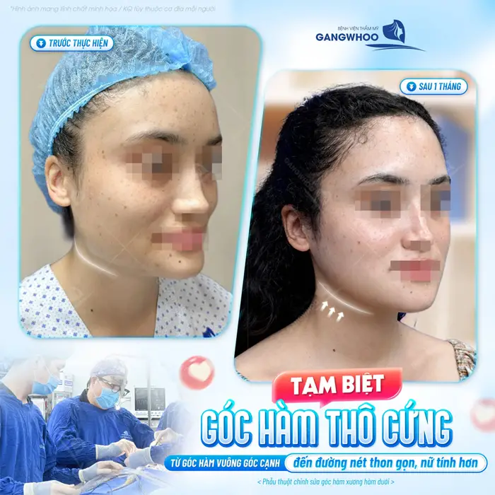 Tạm biệt góc hàm thô cứng từ góc hàm vuông góc cạnh đến đường nét thon gọn và nữ tính hơn 