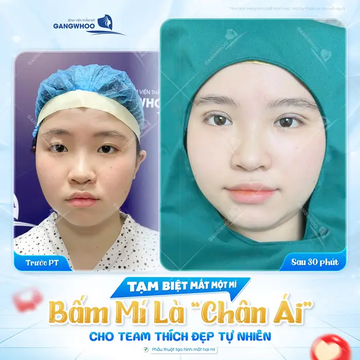 Tạm biệt mắt 1 mí bấm mí là chân ái cho team thích đẹp tự nhiên và hài hòa ngay sau 30 phút