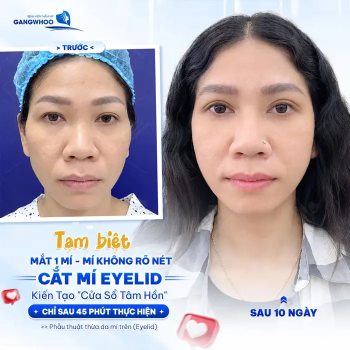 Tạm biệt mắt 1 mí, mí không rõ nét cũng đẹp xuất sắc chỉ sau 45 phút thực hiện 