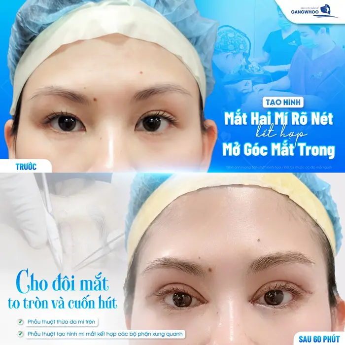 Tạo hình mắt 2 mí rõ nét kết hợp mở góc mắt trong cho đôi mắt thêm to tròn và cuốn hút