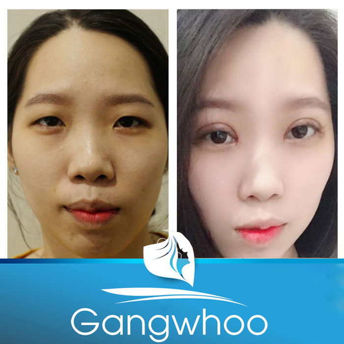 Images of our customers before & after lateral canthoplasty