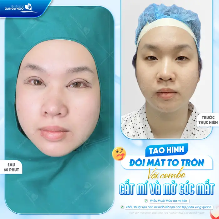 Phẫu Thuật Tạo Hình Mi Mắt Kết Hợp Các Bộ Phận Xung Quanh (Tạo Hình Góc Mắt Trong) 15 Tạo hình đôi mắt to tròn với combo cắt mí và mở rộng góc mắt sau 60 phút đôi mắt đã có điểm nhấn hơn thấy rõ